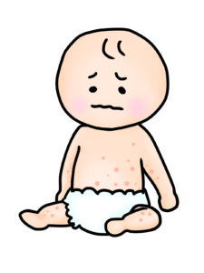 アトピー 対策