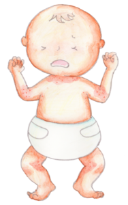 アトピー 食事